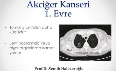 akciger kanseri birinci evre bt görüntüsü