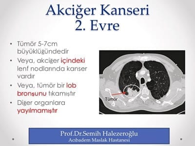 akciğer kanseri ikinci evre bt görüntüsü