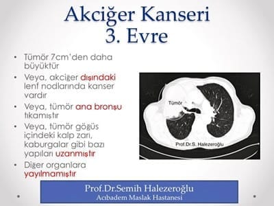 akciğer kanserinde ucuncu evre
